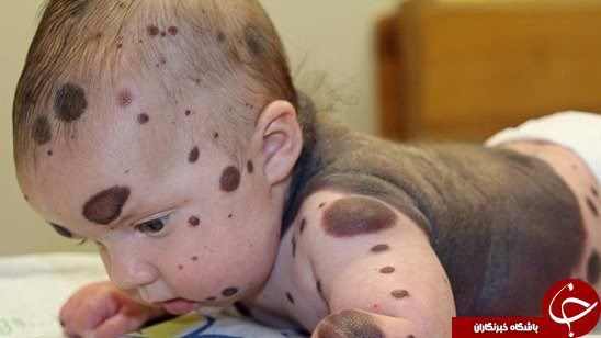 نوزاد خال‌خالی که ۲۶ بار جراحی شد! + تصاویر