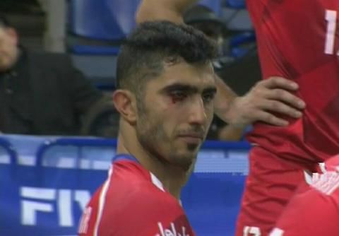 فیلم/ لحظه آسیب دیدگی چشم میرزاجانپور