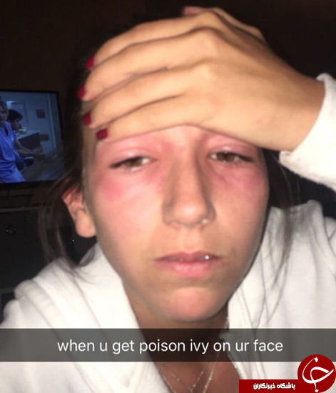 عاقبت تلخ تزریق بوتاکس+ عکس